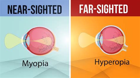 Explain the Difference Between Myopia and Hyperopia