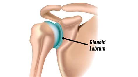 Glenoid Labrum Tear - Symptoms, Causes, Treatment and Rehabilitation