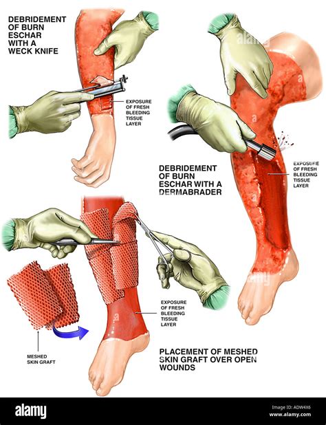 Debridement hi-res stock photography and images - Alamy