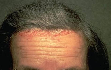 Scalp Psoriasis - Causes &Treatment Options, Natural & Home Remedies