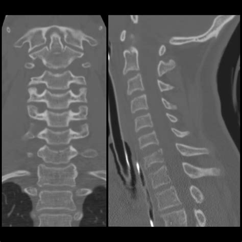 Wedge fracture | pacs