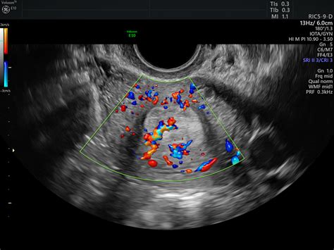 Using Color Doppler Ultrasound for Endometrial Pathology | Empowered ...