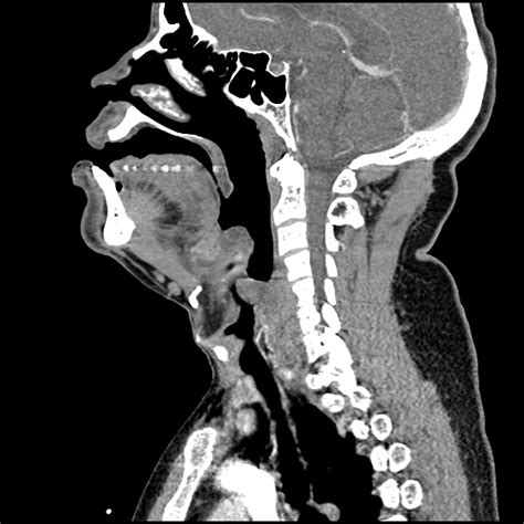 Differential Diagnosis of Epiglottitis