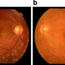 Fundus images obtained at the third photocoagulation procedure. The ...