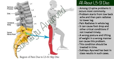 Where Is L5 S1 On Spine