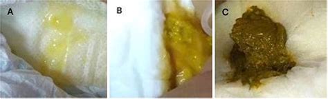 Frontiers | Massive Hydrothorax and Ascites as the Primary ...