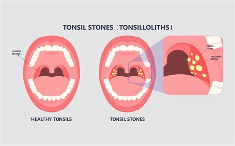 Bad Breath, Sore Throat, and Tonsil Stones - BergerHenry ENT Specialty ...