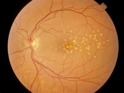 What Are Drusen And Yellow Eye: Causes And Diagnosis