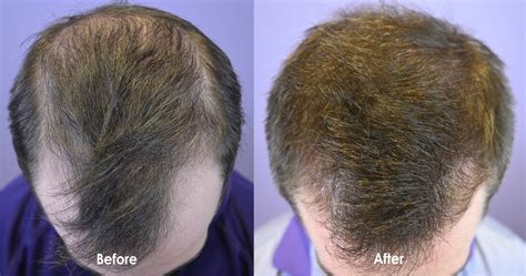 Low Dose Minoxidil Pill Prescribed For Early Hair Loss - Hair ...