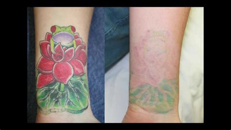 Before and After Color Tattoo Removal - YouTube