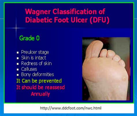 Wagner Ulcer Grade Classification Scale Flashcards | Quizlet