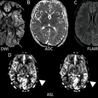 MRI brain demonstrates left hemispheric cortical restricted diffusion ...