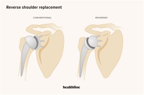 Your Guide to Reverse Shoulder Replacement and Recovery