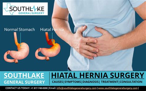 Hiatal Hernia Surgery at Southlake General Surgery, Texas