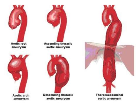 Aortic Aneurysm and Dissection Repair | Patient Care