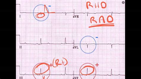 průsečík Bodnout PŘED NAŠÍM LETOPOČTEM. pe ecg expozice Arbitráž Caroline