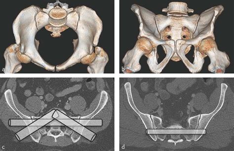 Percutaneous fixation of pelvic fractures—introduction ...