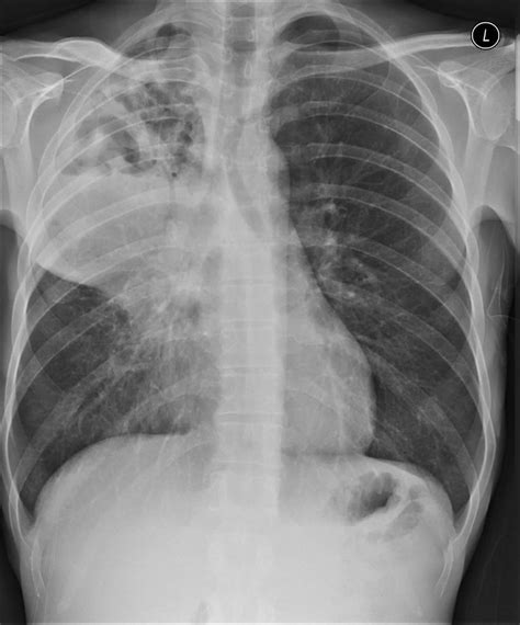 Pulmonary Abscess