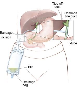 Discharge Instructions: Biliary Catheter | Saint Luke's Health System