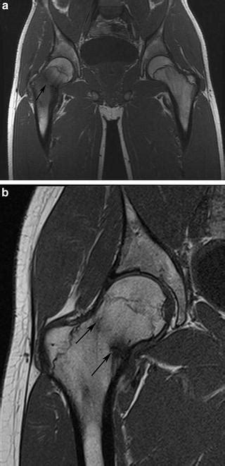 Overview of Diagnostic Imaging of Hip Joint | Radiology Key