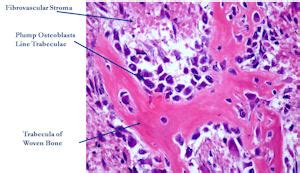 Osteoblastoma Histology