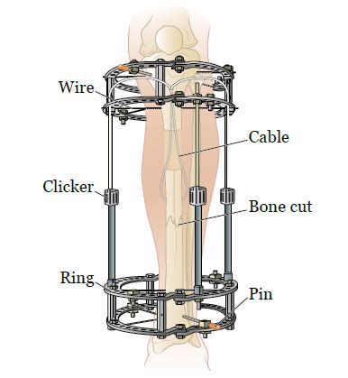 External Fixators by New Tech Need from Ambala Haryana | ID - 5825350