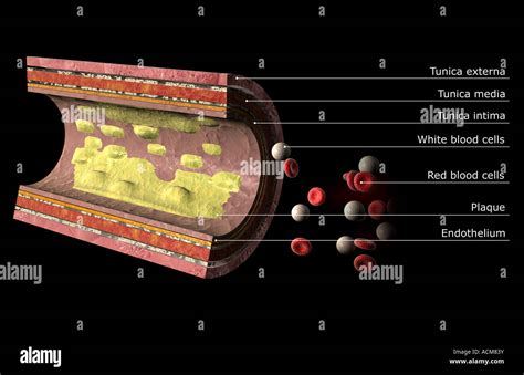 Atheroma plaque fotografías e imágenes de alta resolución - Página 2 ...