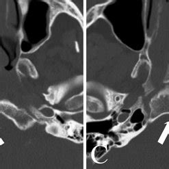 Bone window of CT scan showing transverse clival fracture subtypes ...