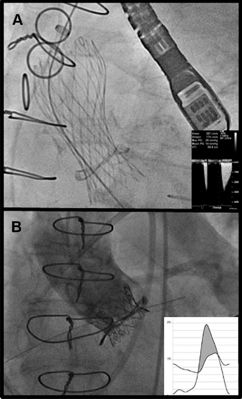 Replacement of aortic valve (procedure) | Semantic Scholar