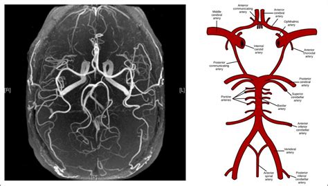 Cerebral Aneurysm Ct