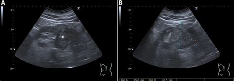 Renal Cancer Ultrasound