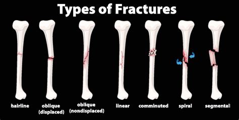 Bone Fractures: Types, Symptoms Treatment, 56% OFF