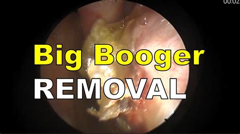 Big Booger Remove - YouTube