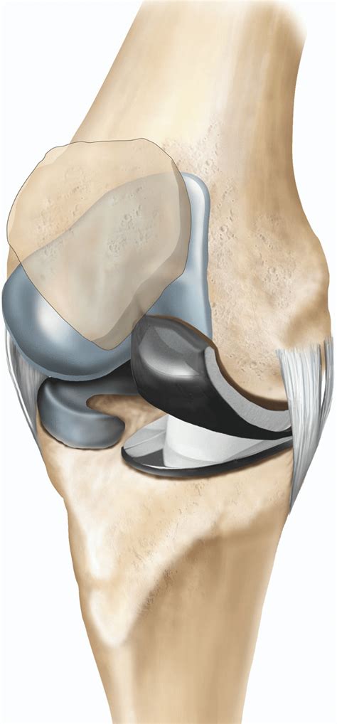 Knee Joint Replacement Devices