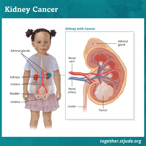 How To Diagnose Kidney Cancer - Soupcrazy1