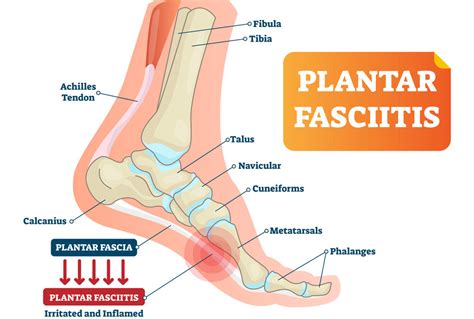 Massage Therapy for Plantar Fasciitis