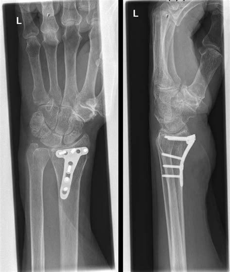 X-ray of wrist AP and axial view | Download Scientific Diagram