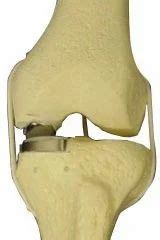 Uni Compartmental Knee Replacement at best price in Mumbai | ID: 6856598512