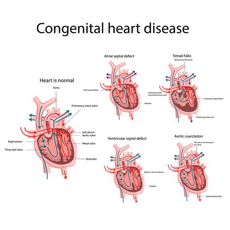 Basics of Congenital Heart Disease – Dr Raghu