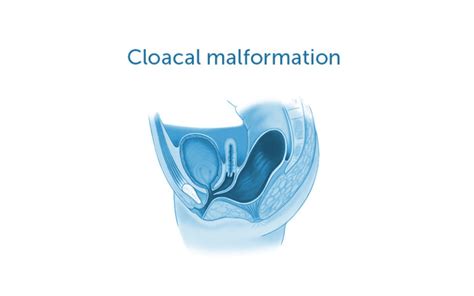 Laparoscopic approach to cloacal malformation repair found safe in ...