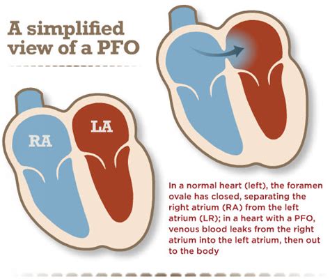 Foramen Ovale