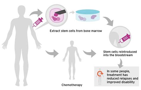 New study shows long term promise of stem cell therapy for MS | MS Society