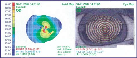 Anterior basement membrane dystrophy (ABMD) corneal topography before ...