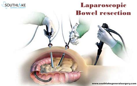 Bowel resection- Why is required? - Recovery Post Surgery - Southlake ...