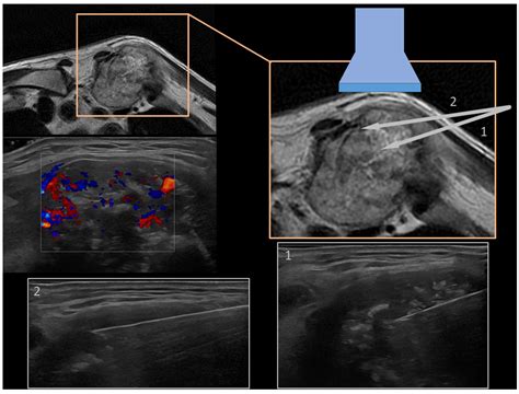 Ultrasound-Guided Percutaneous Bone Biopsy: Feasibility, Diagnostic ...