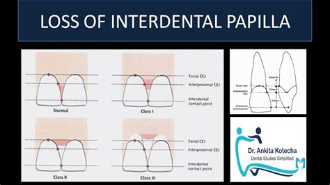 LOSS OF INTERDENTAL PAPILLA| NORDLAND & TARNOW CLASSIFICATION| BLACK ...