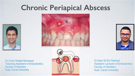 Management of Chronic Periapical Abscess (Arabic) - YouTube