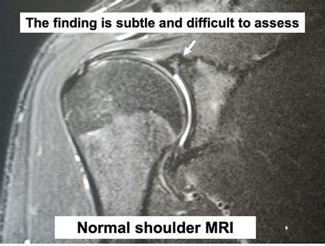 What is a Shoulder MRI arthrogram?