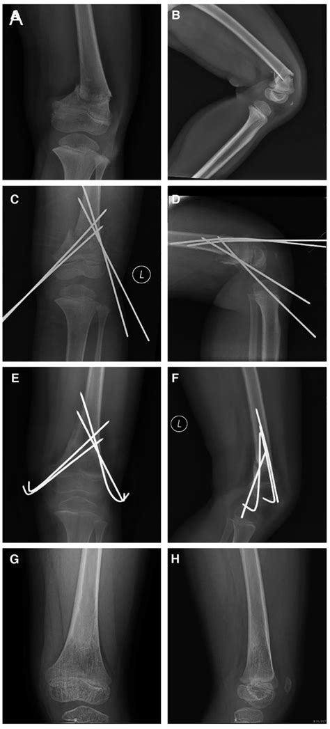 Frontiers | Displaced supracondylar femoral fractures: Clinical and ...