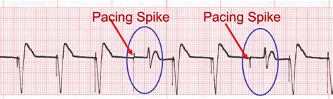 Pacemaker Rhythm ECGs